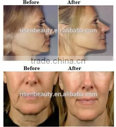 portable thermagic tips/rf thermag/thermag skin tightening machine