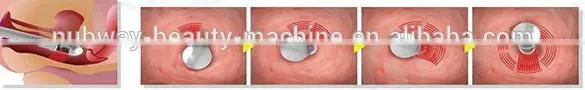 Medical CE FDA Approved Fractional co2 laser for facial resurfacing and ance scars