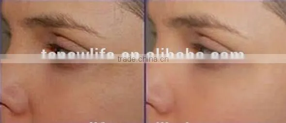 NL-PDT 500 2016 Anti-aging PDT LED facial therapy beauty devices for sale