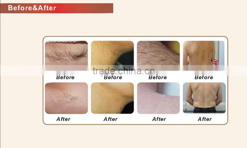 New Style Best Effective Vertical Fast Depilacion Diode Laser Beauty Maquina
