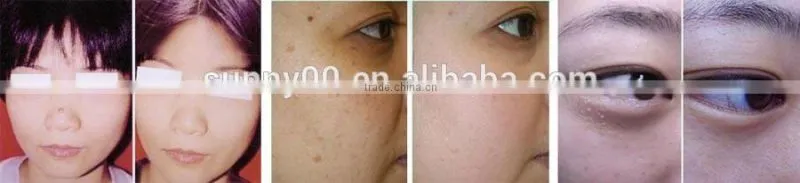 40W Co2 laser Medical co2 laser Sunny Laser