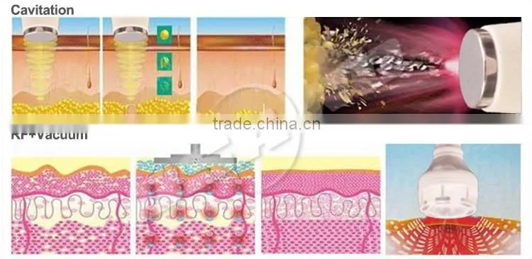 Distributor wantted 5 IN 1 Lipo ultrasound rf cavitation device