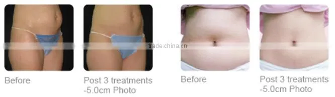 2016 new inventions hifu ultrasonic liposuction cavitation / hifu slimming machine