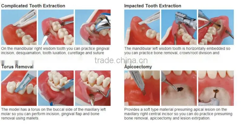 Oral Surgery Jaw Model