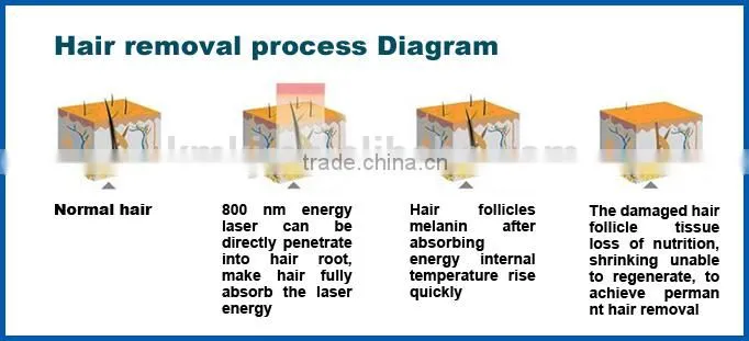 High energy professional salon use 12 bar 808nm laser diodo hair removal