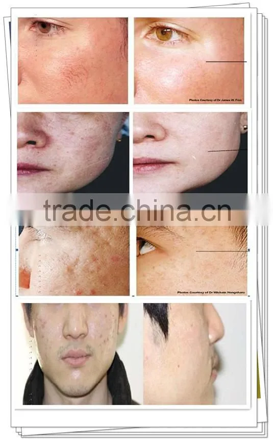 Portable RF Fractional Microneedle Anti-aging Skin Lifting Wrinkle Remover Machine Professional For Beauty Salon