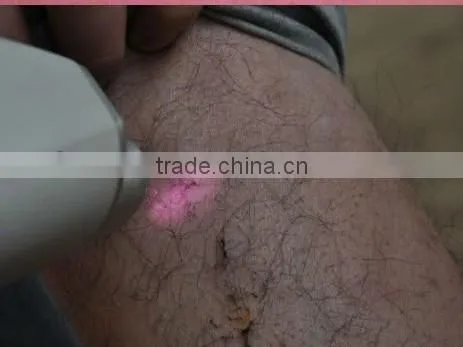 ipl,shr hair removal,vascular/acne removal skin care device