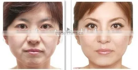 ZGTS derma roller/ 192 derma roller/ microneedle dermaroller