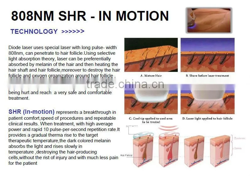 high quality 808nm Diode Laser Hair Removal beauty equipment