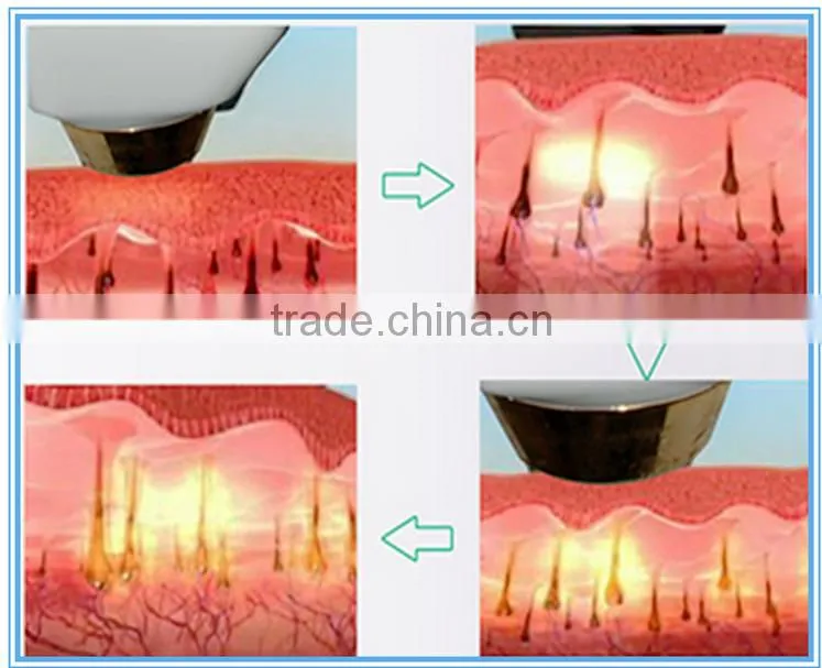 latest technology diode laser hair removal machine
