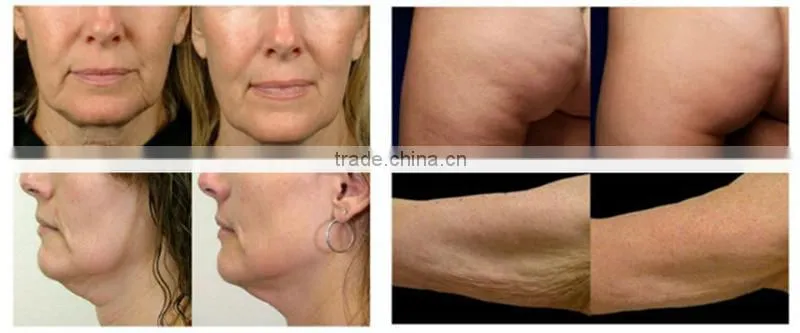 Hot New Products For 2014 Radio Frequency Best Skin Tightening Machine