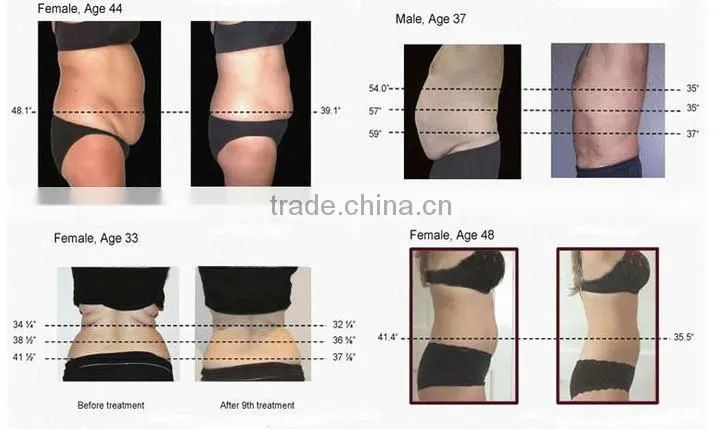 2015 cryolipolysis cellulite therapy machine / cryolipolysis cellulite therapy slimming machine for weight loss