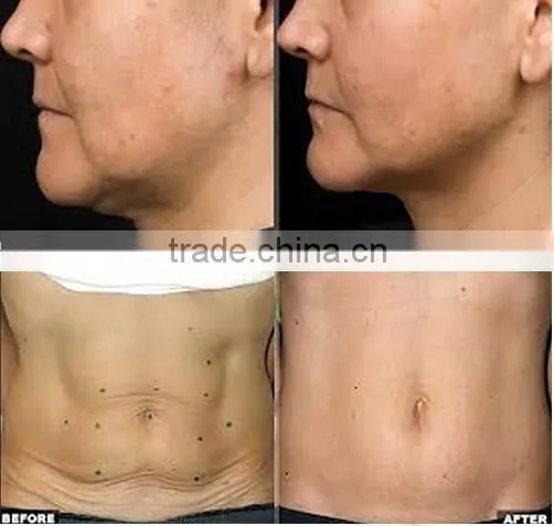 RF Fractional skin rejuvenation beauty equipment salon beauty machine