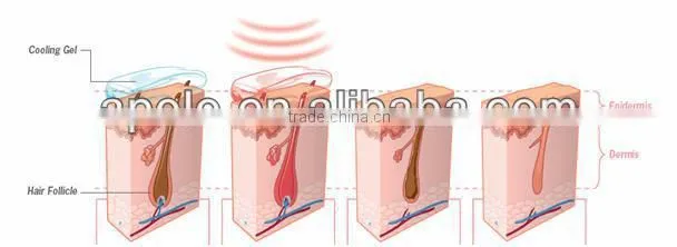 OPT beauty system Apolomed HS300C e-light ipl rf nd yag laser multifunction machine