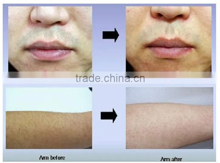 professional hair removal / skin rejuvenation uv laser diode 405nm