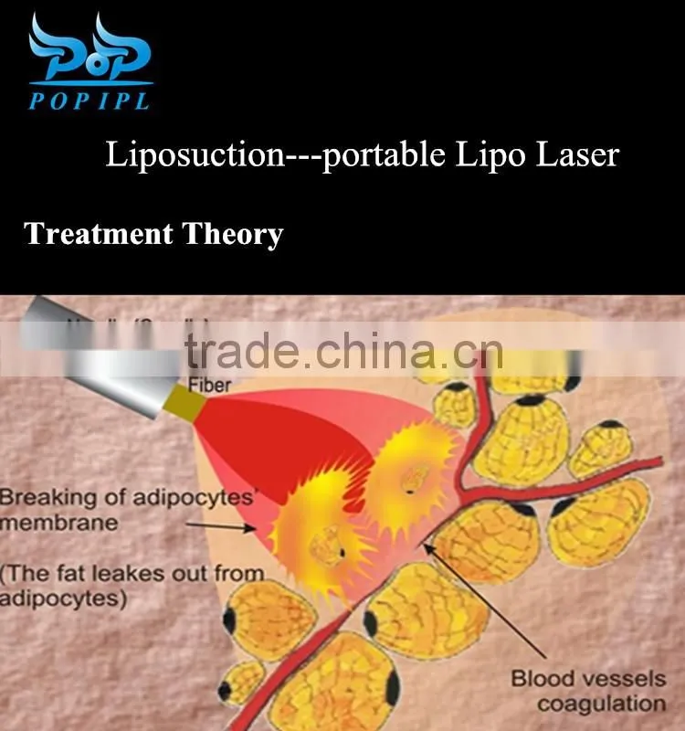 Laser suction portable Lipo Laser Slimming Machine For Weight Loss CHINA POPIPL