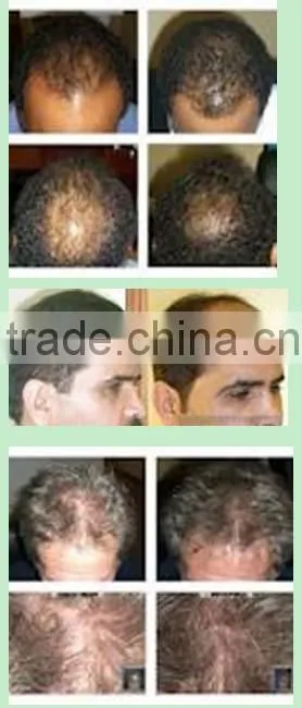 650nm wavelength laser hair therapy machine