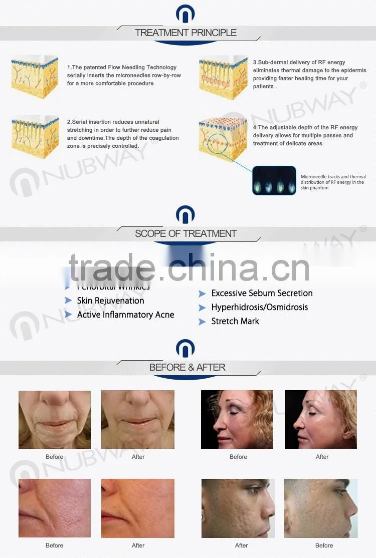 Most effective fractional rf machine for skin rejuvenation microneedle face lifting machine