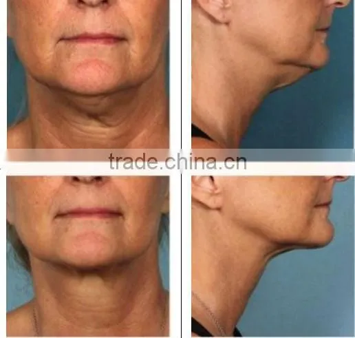 2015 new slimming machine cryo face liposuction