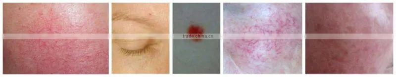 EVLT Laser Spider Vein Removal 980 nm Diode Laser for Whole Body Vascular Lesion Removal