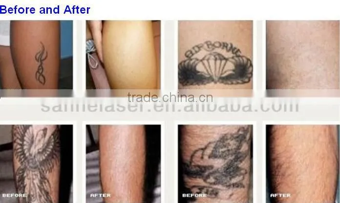 Beijing Factory Direct Selling! laser tattoo removal/pigmentation/freckle removal diode laser equipment with CE appproval