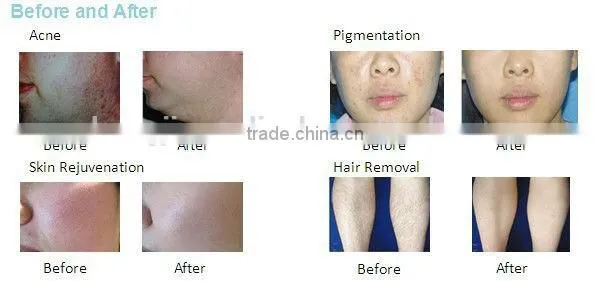 Fractional co2 laser machine stretch marks removal