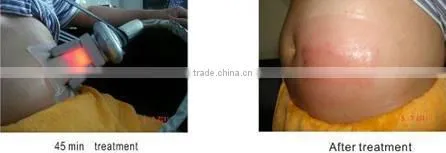 cryolipolysis beauty salon equipment