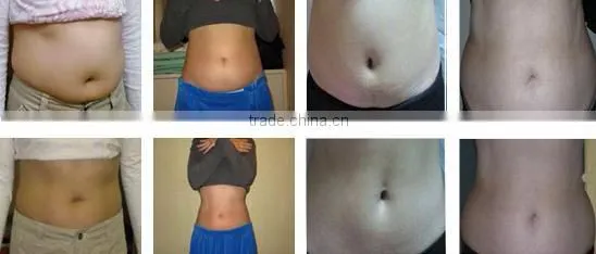 2015 Cryolipolysis Lipo Laser Anti Cellulite Multifunction machine