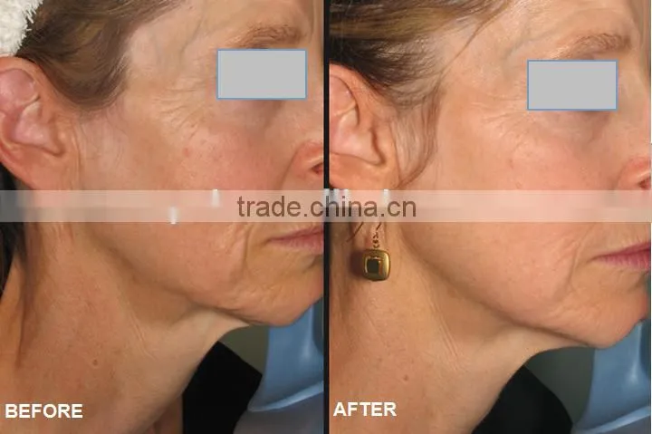Factory supply directly Cavitation and Vacuum slimming system