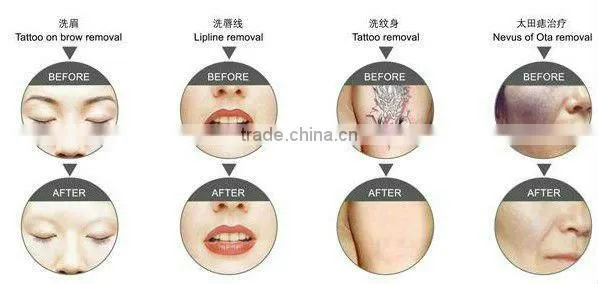 2013 New products Painless Comfertable feeling laser machine for sale on market-D003 for tattoo removal