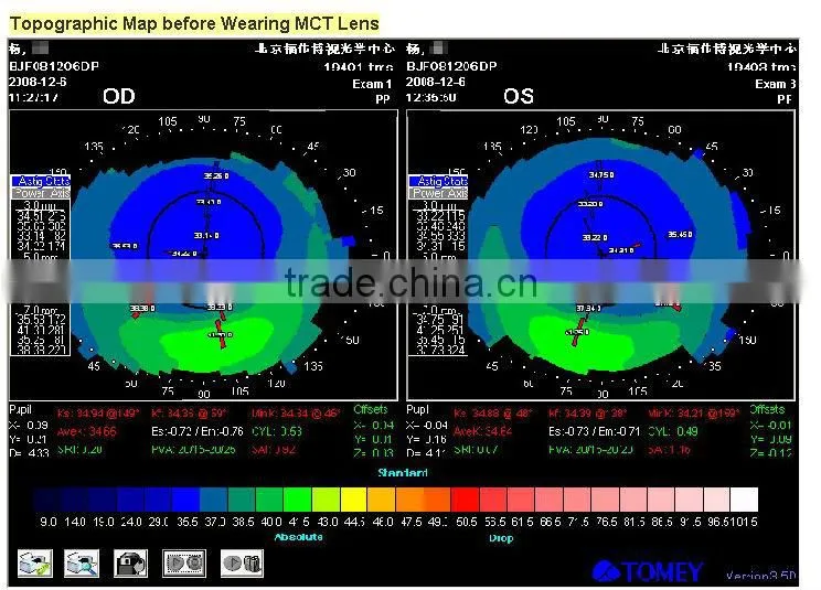 After Laser Surgery/MCT-L/High-end MCT Technology improve of OK Lenses