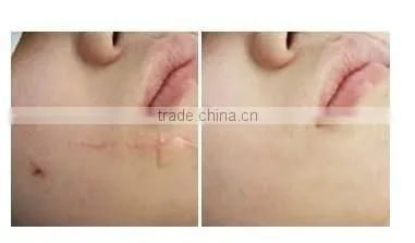 2014 latest laser acne scars REMOVAL non-ablative fractional laser