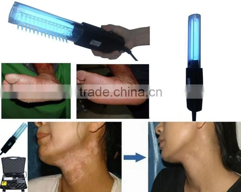 home use 311 nm UVB Lamps for vitiligo/psoriasis/eczema treatment