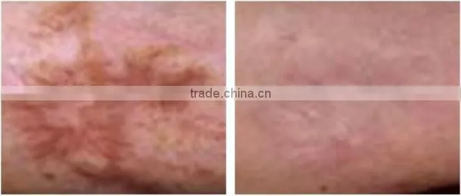Fractional co2 laser machine stretch marks removal