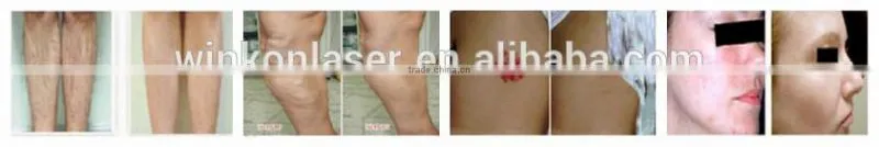 Exclusive hair removal painless long pulse nd yag laser
