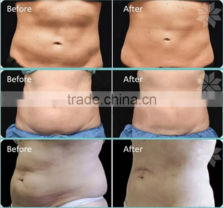medical equipment cavitation rf vacuum laser slimming, skin rejuvenation machine