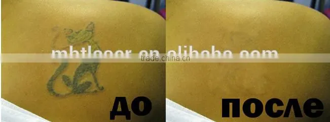 Q-switched nd:yag laser machine in prmotion / Professional Tattoo Removal Machine For Sale