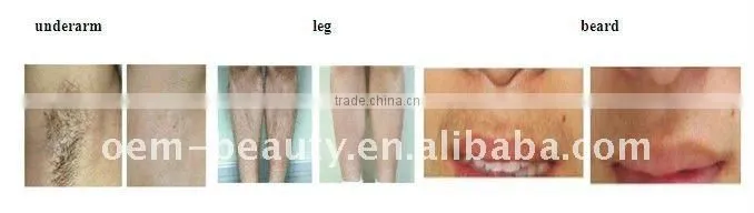 Stationary Hair Removal Machine IPL Laser Equipment-C009