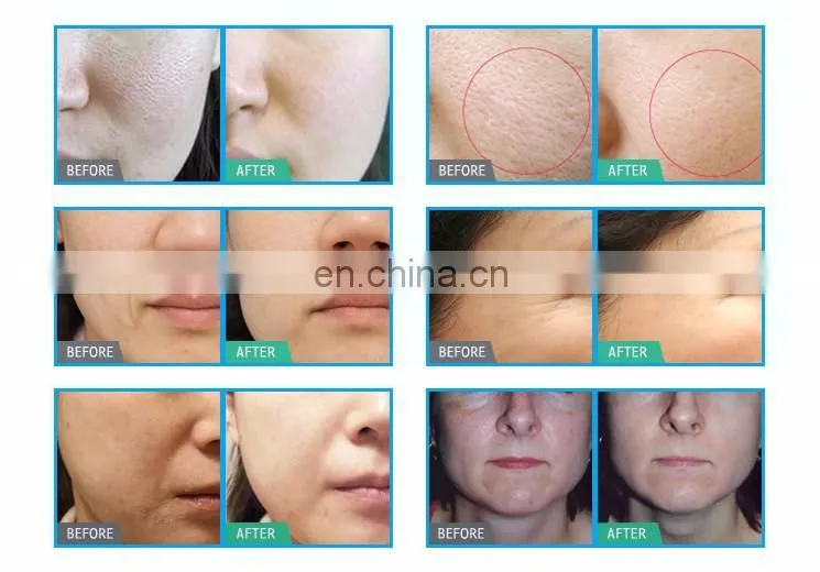 portable home use hydra beauty peel facial dermabrasion machine