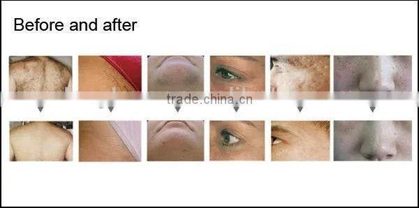 unique ipl laser machine hair removal