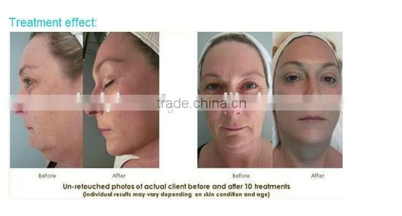 Personal Use Diamond Microdermabrasion Diamond Peel Machine Home