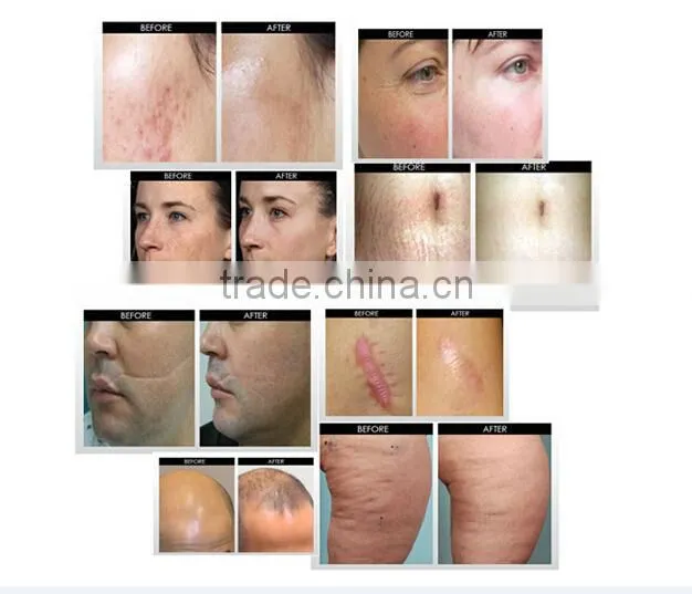 Micro Needle Therapy 4 in 1 derma roller DRS dermaroller Acne Scars Marks Derma Skin Meso Roller