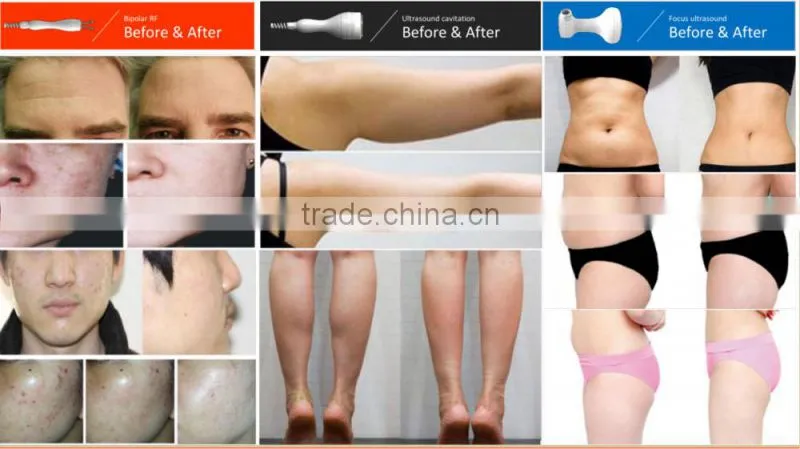 new products 2015 innovative product Hifu slimming/LipoSonix slimming machine