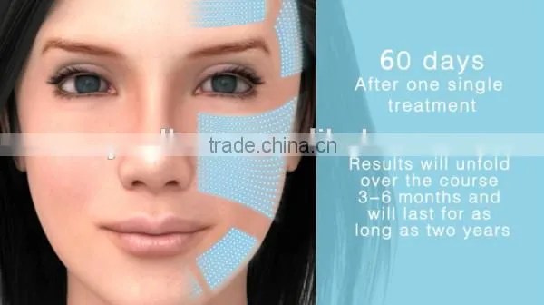 Hot Sale HIFU Ultrasound Machine for Skin Tightening