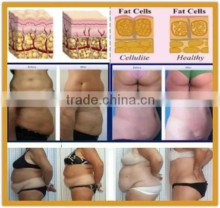 cryolipolysis +cavitation+RF+laser+Vacuum