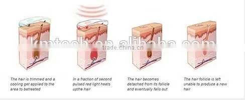 High quality manufacturer!!! Diodo Laser 808nm Diode Laser Hair Removal Machine For Salon