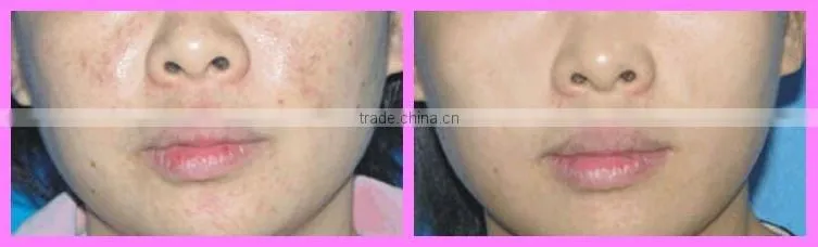 ipl woman facial hair removal