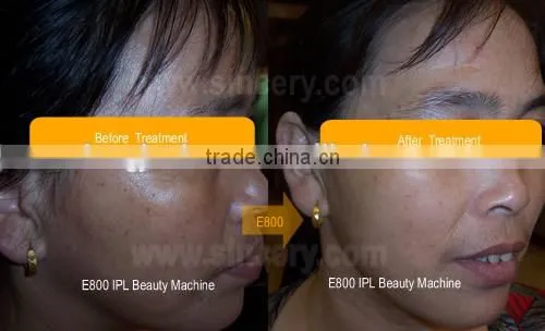 Best choose Beauty Salon Equipment ipl diode laser hair removal machine price