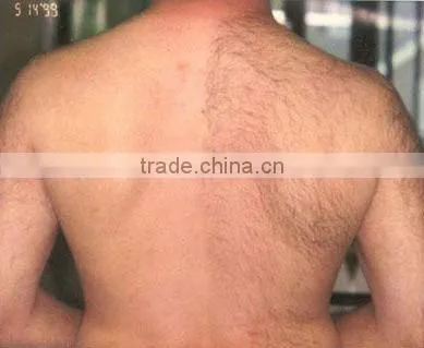 IPL SHR fotodepilacion painless hair removal by shanghai med apolo our company want distributor