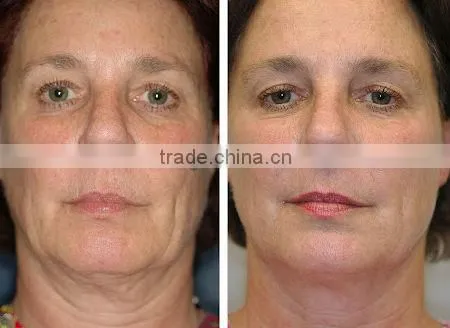 factory low price anti-aging acne removal rf beauty machine with CE certificate F-JT01